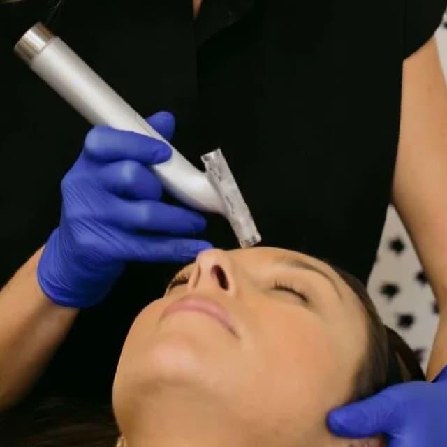 3 Premium Microneedling- Face at Aesthetics by Malory in Lubbock, TX